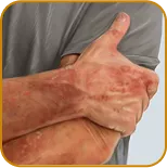Photos representing the organs most commonly involved at baseline among patients in the AGAVE-201 trial: skin, lungs, and joints/fascia.